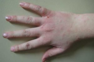 dermatitis