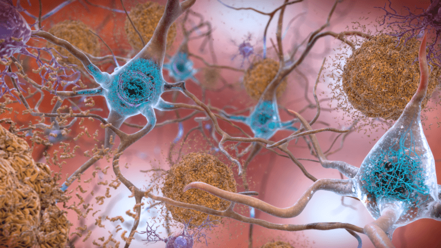In the Alzheimer’s affected brain, abnormal levels of the amyloid-beta protein clump together to form plaques (brown) that collect between neurons and disrupt cell function. Abnormal collections of the tau protein accumulate and tangle (blue) within neurons, harming synaptic communication between nerve cells. Image courtesy of National Institute on Aging, NIH.