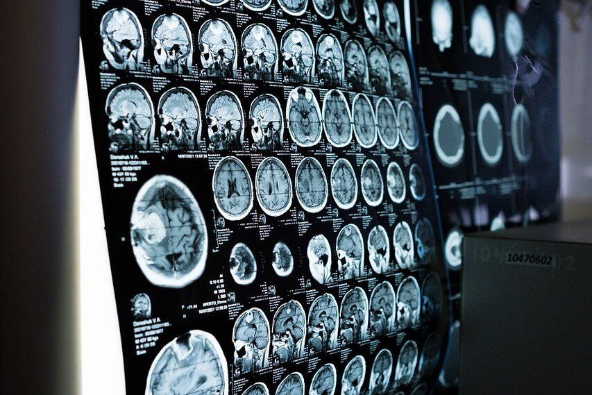 A film of various brain scans seen on a lightbox on a wall