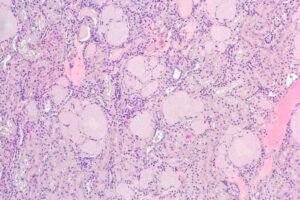 Squirrel kidney cells show signs of amyloid deposits