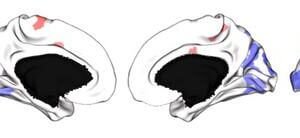 Brain areas with the greatest difference between individuals with and without schizophrenia, with a pronounced negative effect in visual areas of the brain.