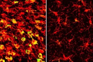 Lipid deposits (green) in brain immune cells (red) from mice with Alzheimer’s-like disease all but disappear (right) after the mice are treated with an experimental drug. Researchers at Washington University School of Medicine in St. Louis have found that a form of cholesterol known as cholesteryl esters builds up in the brains of mice with Alzheimer’s-like disease, and that clearing out the cholesteryl esters helps prevent brain damage and behavioral changes.
