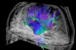 Diffusion tensor imaging, an MRI technique, of the brain.