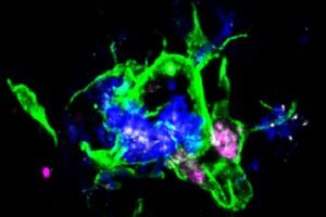 Scientists at Washington University School of Medicine in St. Louis have shown that treating mice with an antibody that blocks the interaction between APOE proteins (white) sprinkled within Alzheimer’s disease plaques and the LILRB4 receptor on microglia cells (purple) activates them to clean up damaging plaques (blue) in the brain.