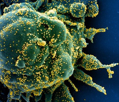 Colorized scanning electron micrograph of an apoptotic cell (green) heavily infected with SARS-COV-2 virus particles (yellow), isolated from a patient sample. (Image credit: NIAID)