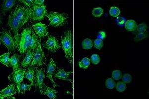 Left: Normal cervical cancer cells with well-formed nuclei in blue and well-organized, elongated actin filaments – which play an essential role in cell survival and division – in green. Right: destabilised cervical cancer cells after gold compound treatment show structural integrity compromised while the nuclei in blue are breaking apart, indicating cell death. 