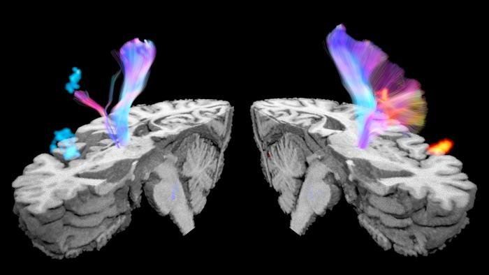 On the right is a visualization of a healthy brain with intact cortical neuronal connections between the cortex and spinal cord, with brain areas active during volitional voiding of the bladder. The brain of a stroke patient with damaged connections and brain areas that are hypoactive is on the left.