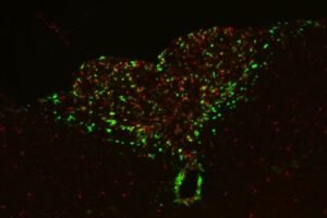 Researchers at WashU Medicine identified a direct connection between cancer-related inflammation and the loss of motivation characteristic of advanced cancer. In a mouse study they describe a brain pathway that starts with neurons (labeled in green, above) that sense inflammation signals, and the researchers were able to treat the loss of motivation by blocking this pathway.