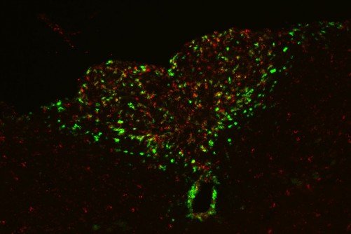 Researchers at WashU Medicine identified a direct connection between cancer-related inflammation and the loss of motivation characteristic of advanced cancer. In a mouse study they describe a brain pathway that starts with neurons (labeled in green, above) that sense inflammation signals, and the researchers were able to treat the loss of motivation by blocking this pathway.
