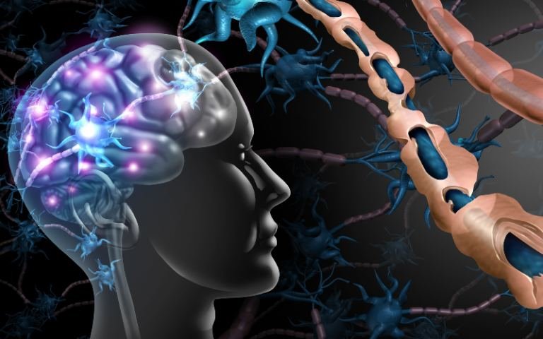 abstract illustration of M S in human body